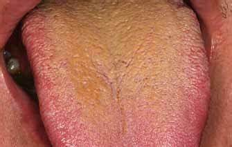 The following list of conditions have 'yellow tongue in children' or similar listed as a symptom in our database. Coated tongue, due to insufficient brushing or scraping of ...