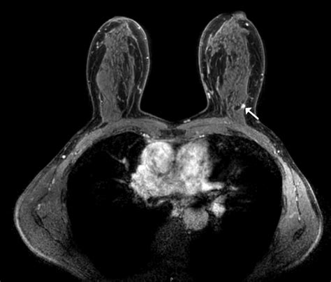 Supplemental Breast Mri For Women With Extremely Dense Breasts Results