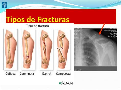 Ppt Fracturas Powerpoint Presentation Free Download Id2941437