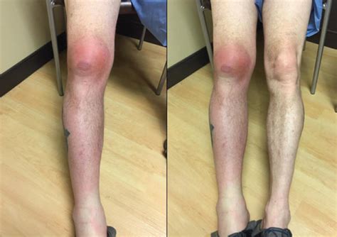 Right Leg Prepatellar Bursitis With Extension Of Inflammation To The