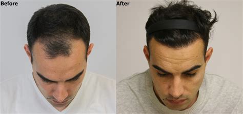 Fue Hair Restoration Grafts Alvi Armani Hair Transplant Los