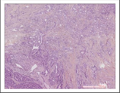 Figure 1 From Composite Mucoepidermoid Carcinoma And Columnar Cell