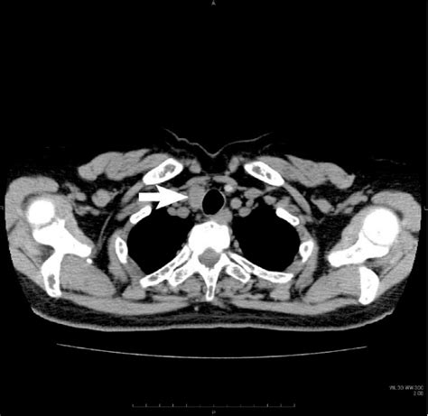 Figure 2 From Recurrent Hyperparathyroidism Due To Parathyroid And