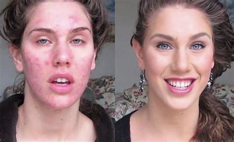 Girl Reveals Her Impressive Makeup Skills That Help Cover Her Scaly