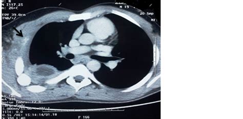 Tuberculous Pleuro Cutaneous Fistula