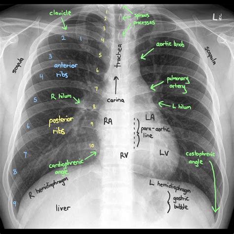 34+ listes de stomach ribs lungs picture! Reading Chest X-Rays | RK.md