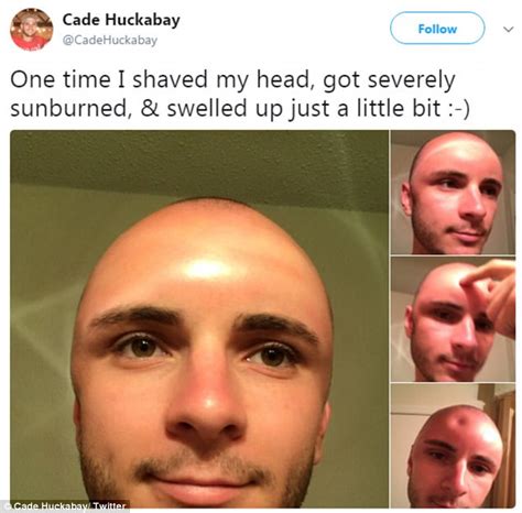 Man Sunburned So Badly He Poked A Dent In His Forehead Daily Mail Online