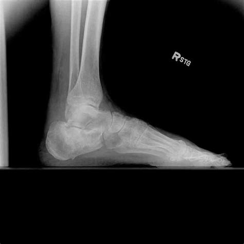 Figure Ankle Radiograph Lateral Calcaneus Fracture Contributed By