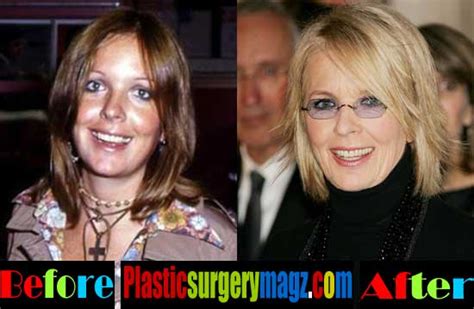 Diane Keaton Plastic Surgery Before And After Photos Plastic Surgery Magazine