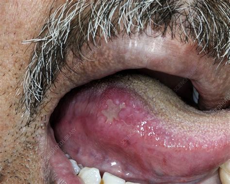 Aphthous Ulcer On The Tongue Stock Image C0166983 Science Photo