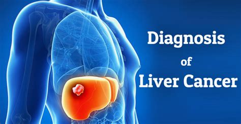 Liver Cancer Types And Stages