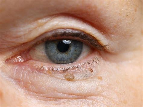 Cholesterol Bumps Due To The Accumulation Of Cholesterol On The Eyes