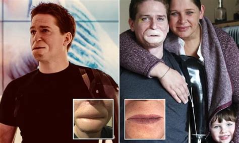 Father Who Lost His Limbs And Lips To Deadly Infection Says Facial Surgery Has Transformed His