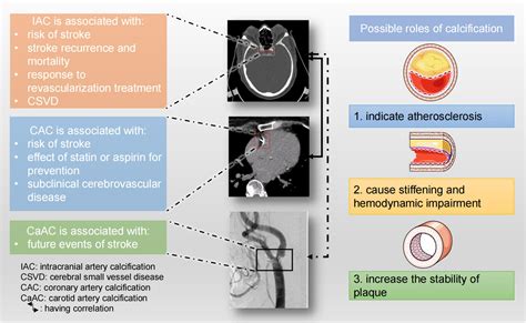 Frontiers Arterial Calcification And Its Association With Stroke