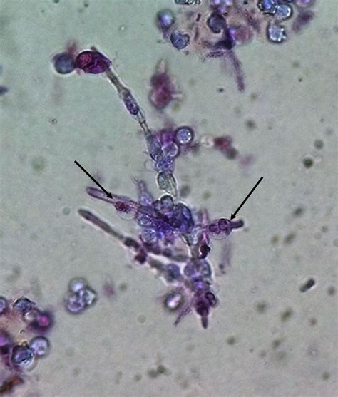 Urine Sediment Of The Month Identifying Phagocytosed Particles Bipmd