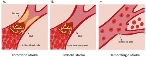 3 2 Stroke And Loss Of Blood Flow As An Acute Injury To The Brain