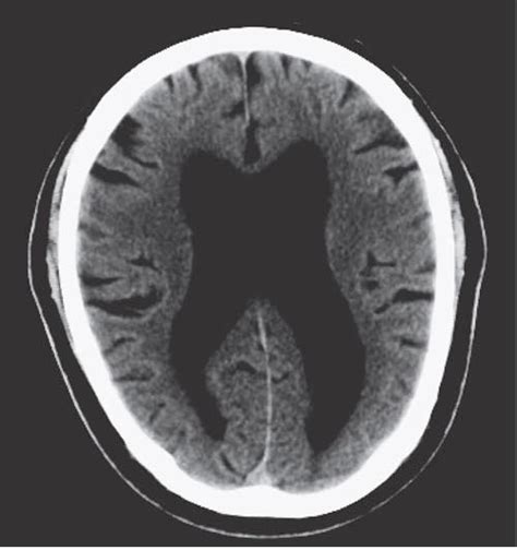 Study Medical Photos Differential Diagnosis Of Normal Pressure