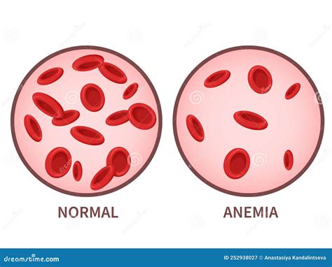 Hemoglobin Anemia Symptoms Blood Disease Health Care Concept Stock