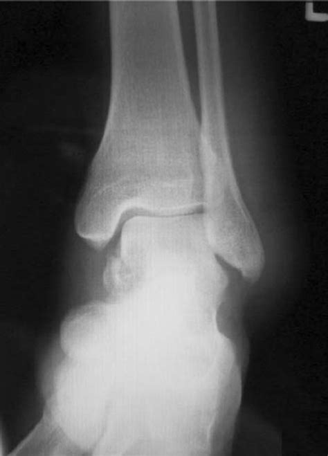 Anteroposterior X Ray Image Showing Ankle Joint With Inhomogeneous