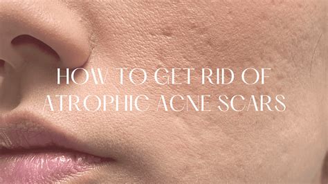 How To Get Rid Of Atrophic Acne Scars Realistic Ways Hello Mia Wilson