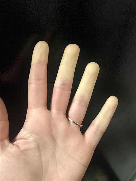 Loss Of Blood Flow To My Fingers Due To Raynauds Disease
