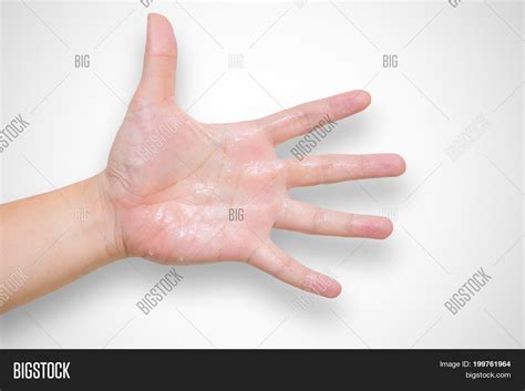 Hyperhidrosis Wet Male Image And Photo Free Trial Bigstock