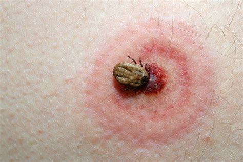 Tick Bite Symptoms And Treatments Everyone Should Know About Pest Wiki