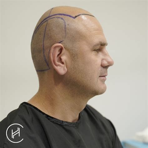 32 Completely Bald Hair Transplant Janineraigan