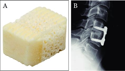 A Structural Interbody Spacer With Cancellous Bone Sandwiched Between
