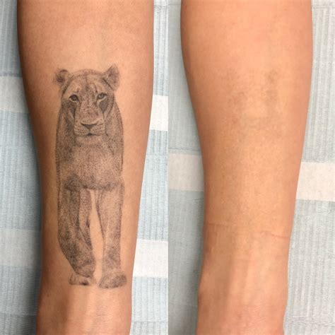 Laser Tattoo Removal Vancouver Bc Adrenaline Studios