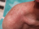Prickly Heat Rash: Treatments, Causes, and More