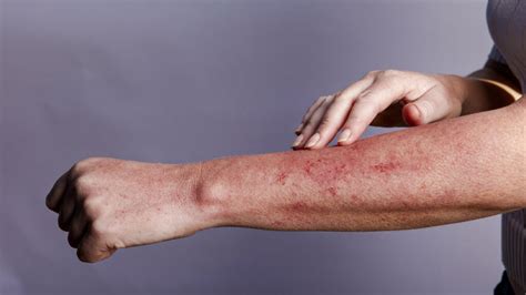 Hiv Rash Types Causes Other Symptoms When To See A Doctor