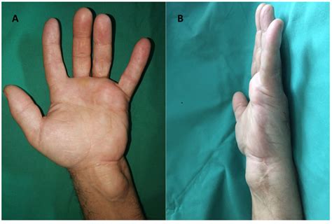 Diagnostics Free Full Text Atypical Sites Of The Lipoma On The Hand