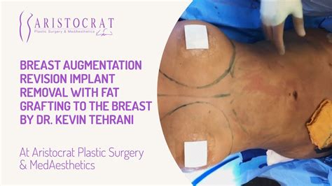 Breast Augmentation Revision Implant Removal With Fat Grafting To The