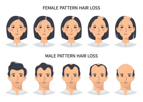 hair loss stages androgenetic alopecia male and female pattern steps of baldness vector