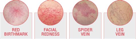 Facial Redness Rosacea Red Birthmarks Spider And Leg Veins