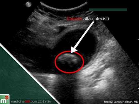 Sebbene non siano ancora state chiarite del tutto le cause per cui si formano i calcoli alla colecisti, i ricercatori hanno evidenziato come l'alimentazione svolga un ruolo importante.diversi studi hanno messo in correlazione il sovrappeso e l'obesità con l'aumento del rischio di soffrire di calcoli biliari. Calcoli alla colecisti: sintomi e cure: dieta ed ...
