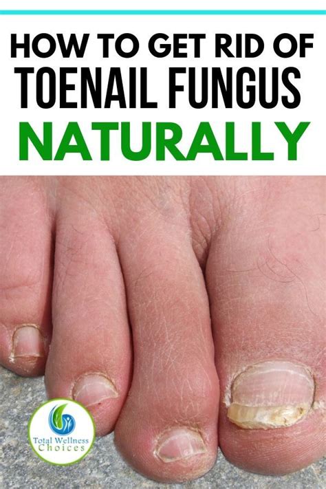 9 Best Natural Home Remedies For Toenail Fungus Toenail Fungus
