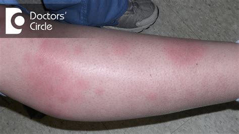 Erythema Nodosum Arms