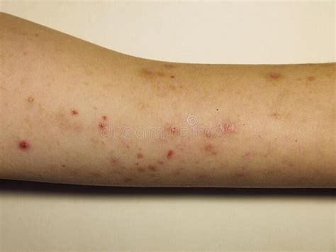 Skin Allergic Irritations In The Form Of A Rash Stock Photo Image Of