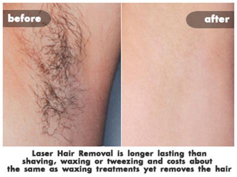 The price is always discussed beforehand with a nurse during your free laser hair removal consultation. Laser Hair Removal Costs | St. Louis Laser Liposuction Center