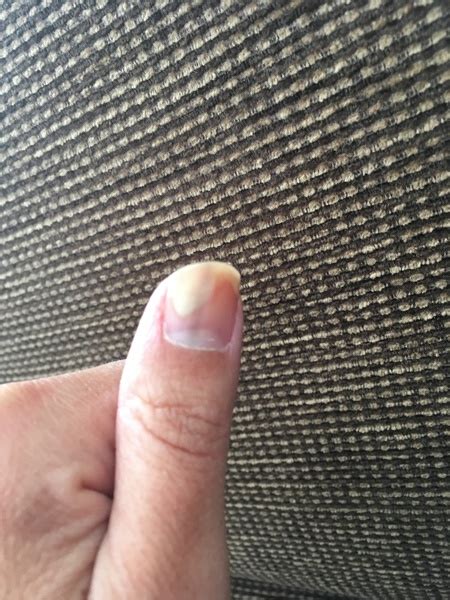 Vertical lines are just a natural part of the nail. Dark vertical line on thumb nail | Mumsnet