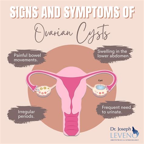 Signs And Symptoms Of Ovarian Cysts Dr Joseph Leveno