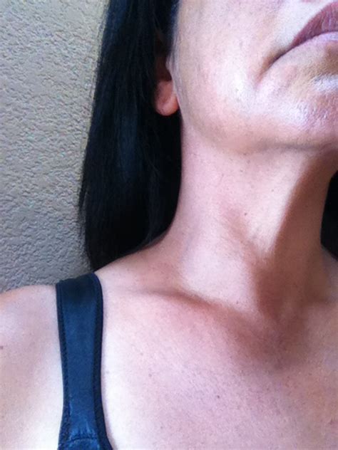 Thyroid Goiter And Nodules 101 What You Need To Know Part Two