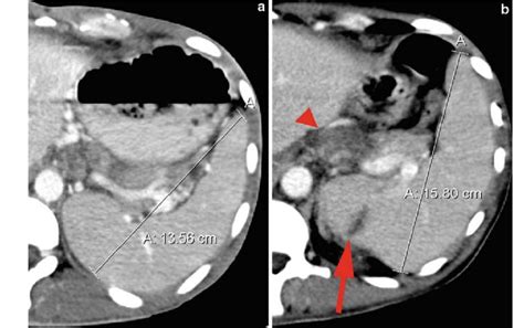 A Contrast Enhanced Transverse Ct Of The Abdomen Showing The Size Of