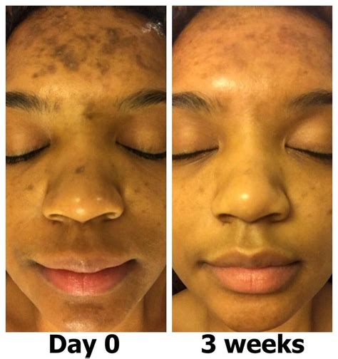 A Dark Spot Corrector If Melasma Or Other Types Of Hyperpigmentation