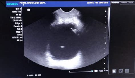 Usg Of Urinary Bladder Showing Rent In Antero Lateral Surface