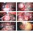 Chapter 27 – Laparoscopic Surgery For Ovarian Cyst Melaka Fertility