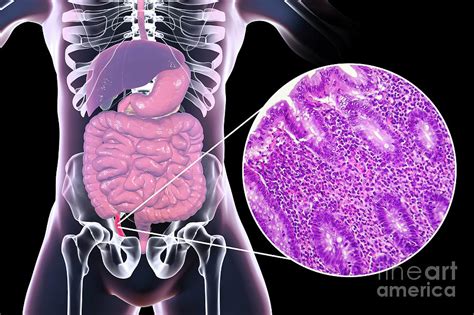 Acute Suppurative Appendicitis Photograph By Kateryna Konscience Photo