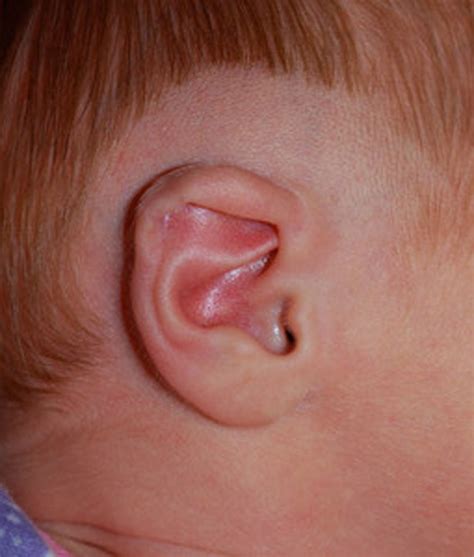 Ear Lidding Deformity Earwell® Infant Ear Correction System